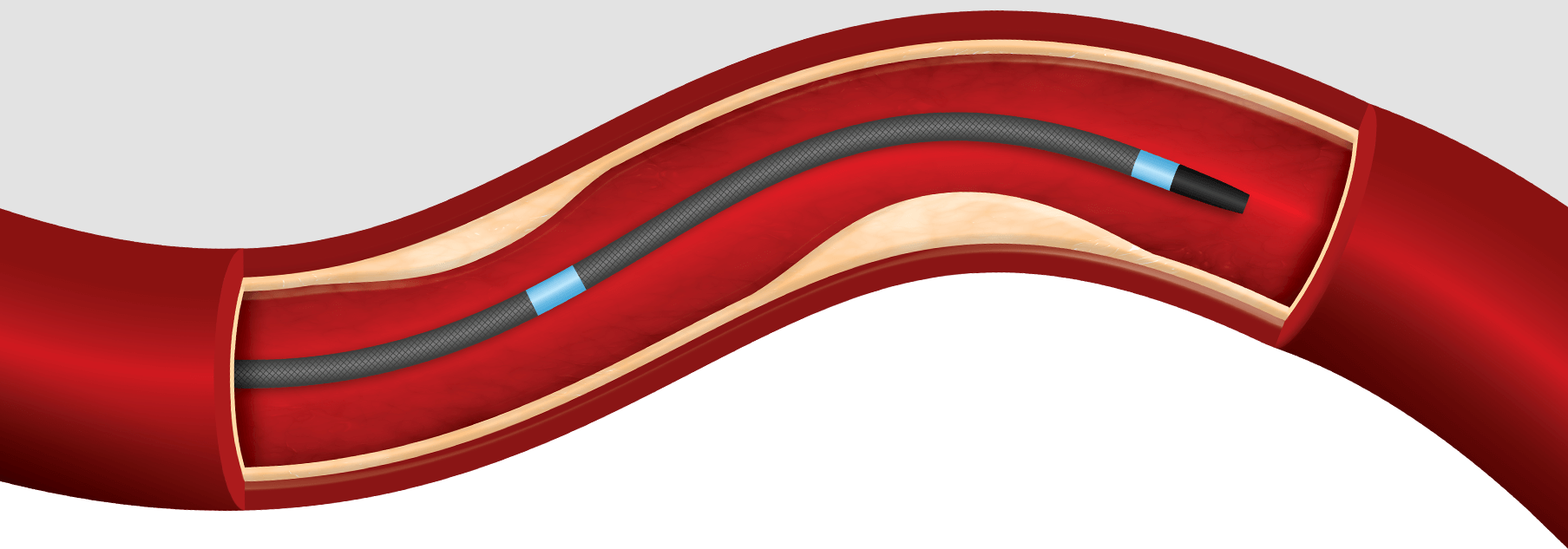 spexLP - Reflow Medical